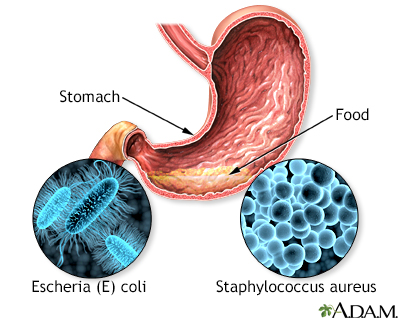 Food poisoning Food poisoning
