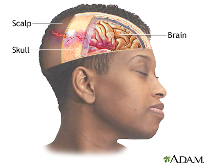 Head injury Head injury