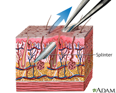 Splinter removal Splinter removal