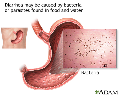 Diarrhea Diarrhea