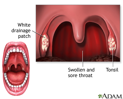Strep throat Strep throat