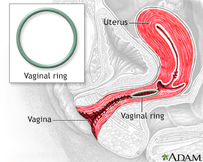 Vaginal ring Vaginal ring