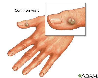 Wart Wart