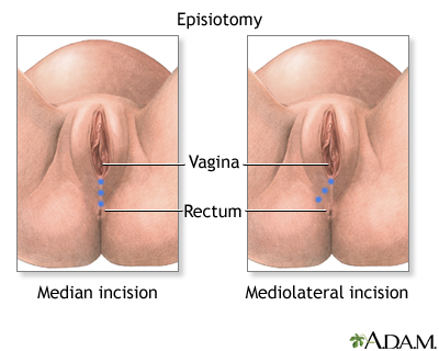 Episiotomy Episiotomy