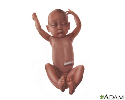 Low Birth Weight Baby Low Birth Weight Baby