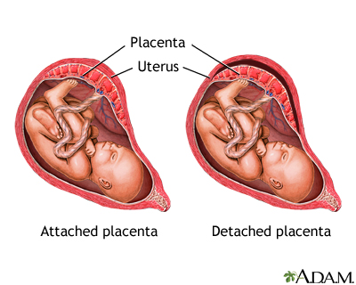Abruptio Placenta Abruptio Placenta