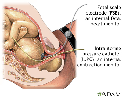 Internal Fetal Monitoring Internal Fetal Monitoring