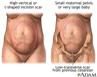 Vaginal Birth after C-Section Vaginal Birth after C-Section