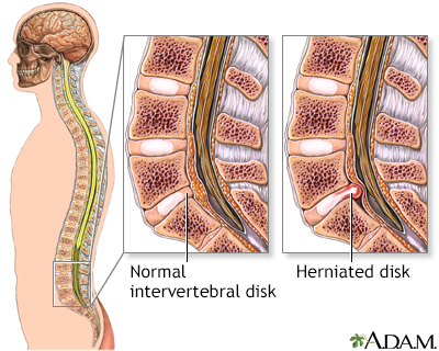 Microdiskectomy: normal anatomy Microdiskectomy: normal anatomy