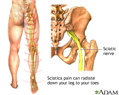 Sciatica Sciatica