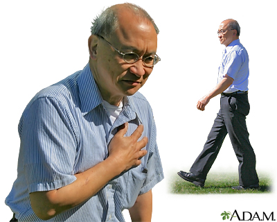 Stable angina Stable angina