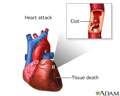 Heart attack Heart attack