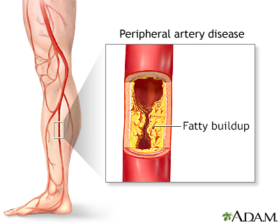 Peripheral artery disease (PAD) Peripheral artery disease (PAD)