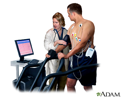 Exercise stress test Exercise stress test