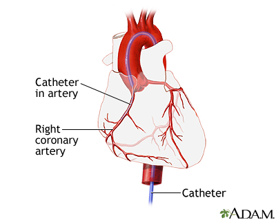 Coronary angiography Coronary angiography