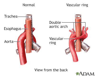 Vascular ring Vascular ring