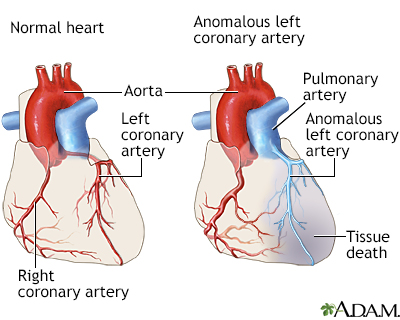 Anomalous left coronary artery Anomalous left coronary artery
