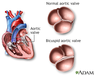 Bicuspid aortic valve Bicuspid aortic valve