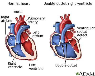Double outlet right ventricle Double outlet right ventricle