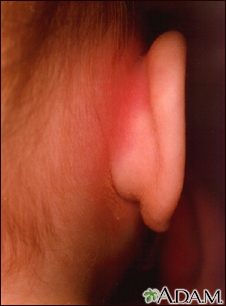 Mastoiditis - redness and swelling behind ear Mastoiditis - redness and swelling behind ear