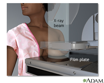 Mammogram Mammogram