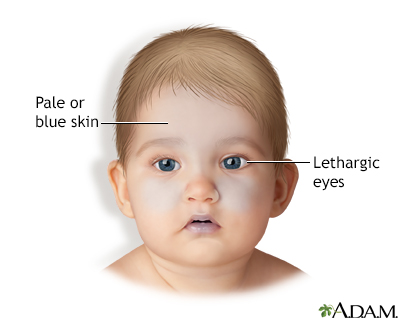 Shaken baby symptoms Shaken baby symptoms