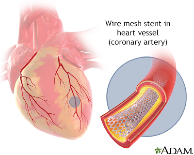 Coronary artery stent Coronary artery stent