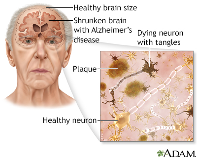 Alzheimer's disease Alzheimer's disease