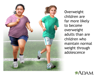 Childhood obesity Childhood obesity