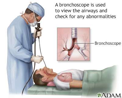 Bronchoscopy Bronchoscopy