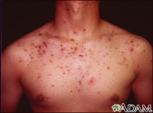 Acne, cystic on the chest Acne, cystic on the chest