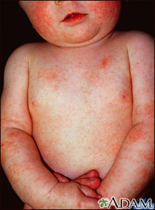 Dermatitis, atopic in an infant Dermatitis, atopic in an infant