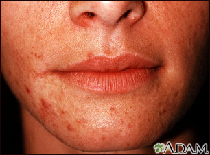 Dermatitis, perioral Dermatitis, perioral