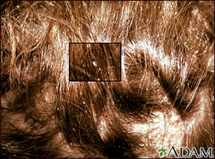 Lice, head - nits in the hair with close-up Lice, head - nits in the hair with close-up