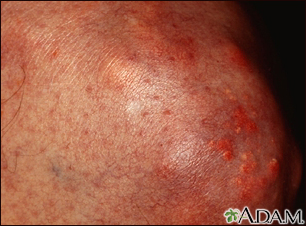 Xanthoma on the knee Xanthoma on the knee