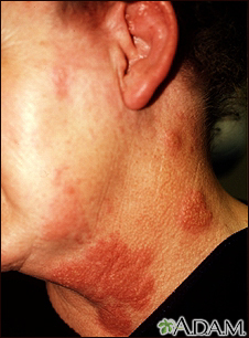 Herpes zoster (shingles) on the neck and cheek Herpes zoster (shingles) on the neck and cheek