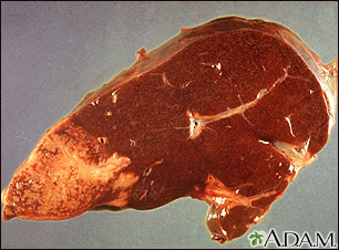 Hodgkin's disease, liver involvement Hodgkin's disease, liver involvement