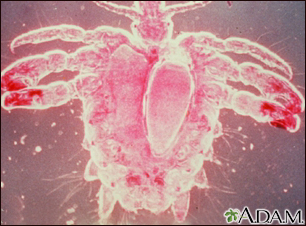 Crab louse, female Crab louse, female