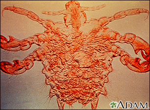 Pubic louse-male Pubic louse-male