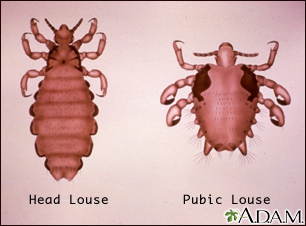 Head louse and pubic louse Head louse and pubic louse