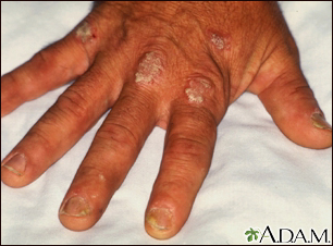 Psoriasis on the knuckles Psoriasis on the knuckles