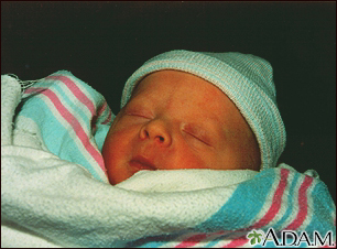Jaundice infant Jaundice infant
