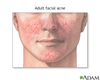 Adult facial acne Adult facial acne