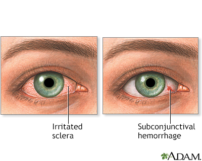 Bloodshot eyes Bloodshot eyes