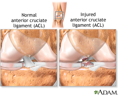 Anterior cruciate ligament (ACL) injury Anterior cruciate ligament (ACL) injury