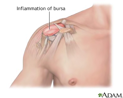 Bursitis of the shoulder Bursitis of the shoulder