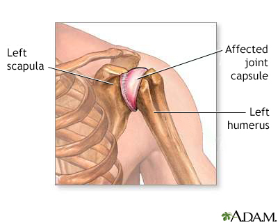 Shoulder joint inflammation Shoulder joint inflammation