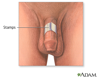 Erection self-test Erection self-test