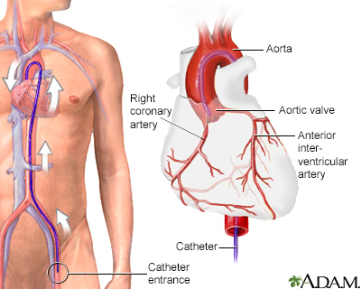 Cardiac arteriogram Cardiac arteriogram