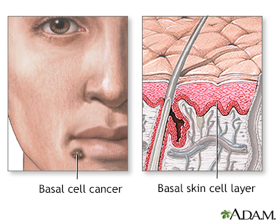 Squamous cell cancer Squamous cell cancer